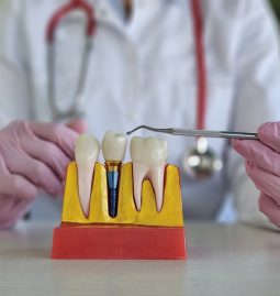 What Factors Influence the Cost of Dental Implants?