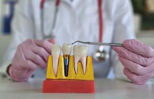 What Factors Influence the Cost of Dental Implants?