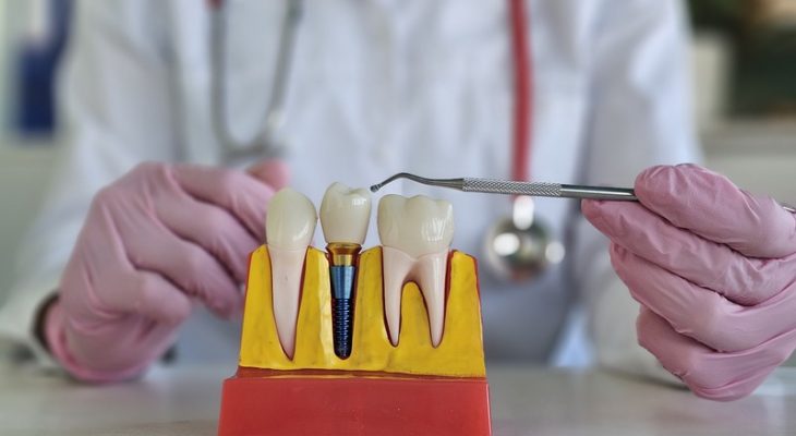 What Factors Influence the Cost of Dental Implants?