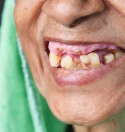 What Are the Health Impacts of Poor Oral Hygiene