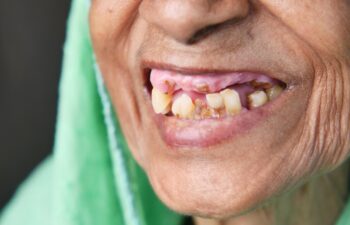 What Are the Health Impacts of Poor Oral Hygiene